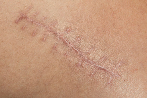 Scar tissue massage